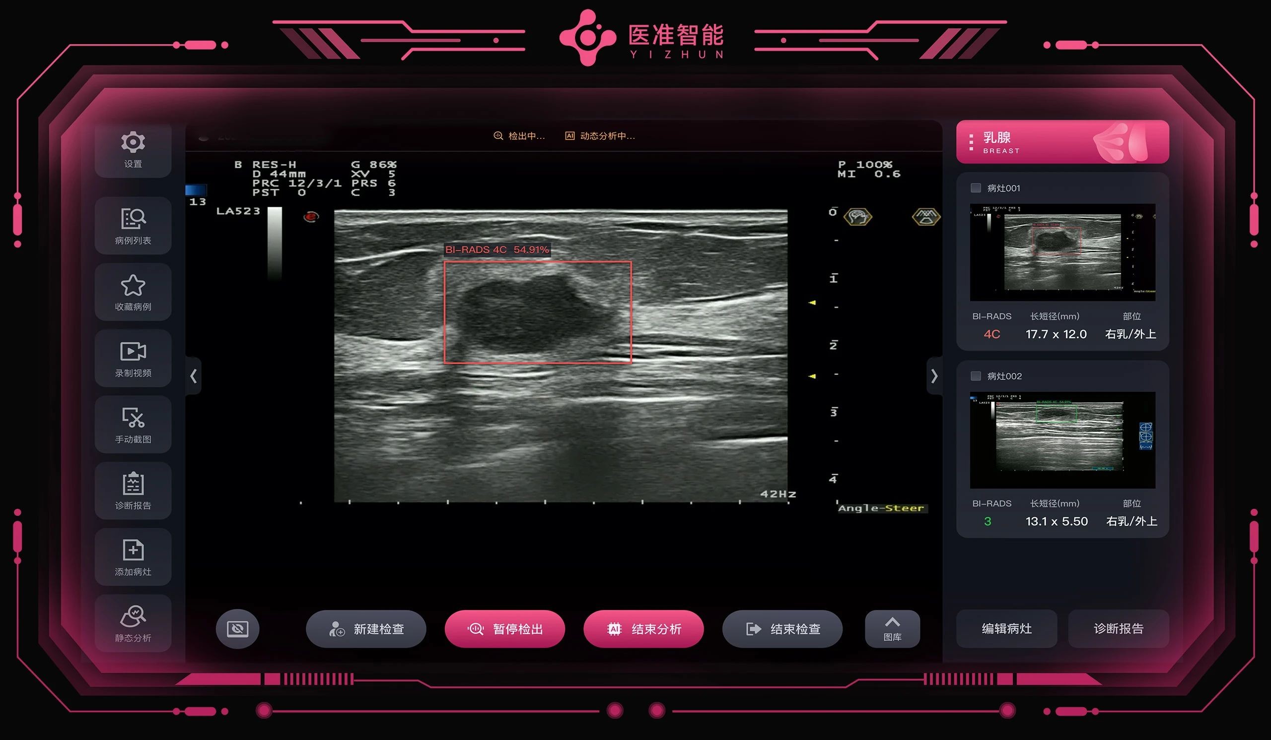 医准智能斩获首张乳腺超声AI三类证，万孚生物产业基金入股